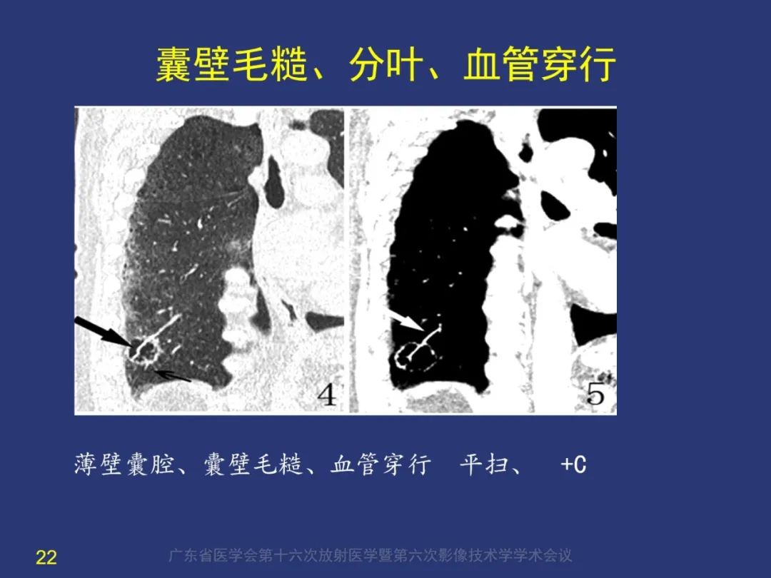 影像PPT - 【PPT】囊腔性肺癌的影像特征和鉴别诊断-22