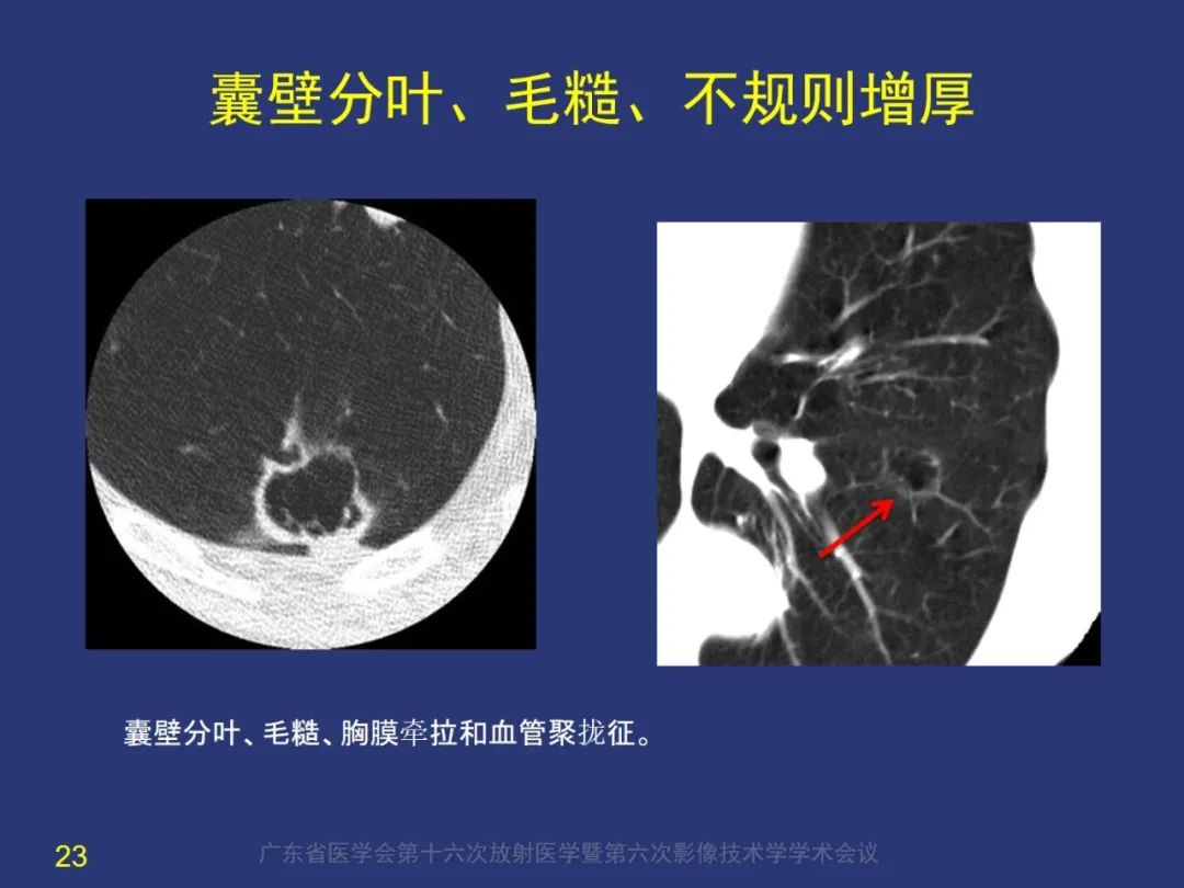 影像PPT - 【PPT】囊腔性肺癌的影像特征和鉴别诊断-23