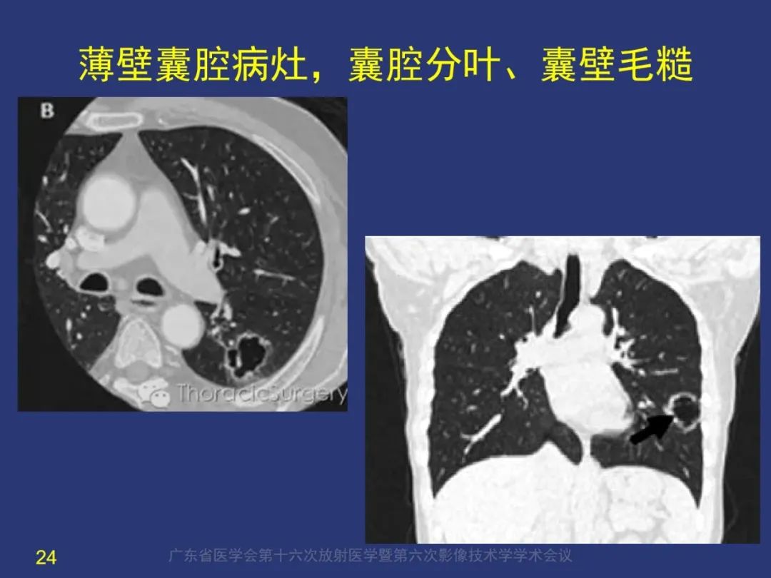 影像PPT - 【PPT】囊腔性肺癌的影像特征和鉴别诊断-24