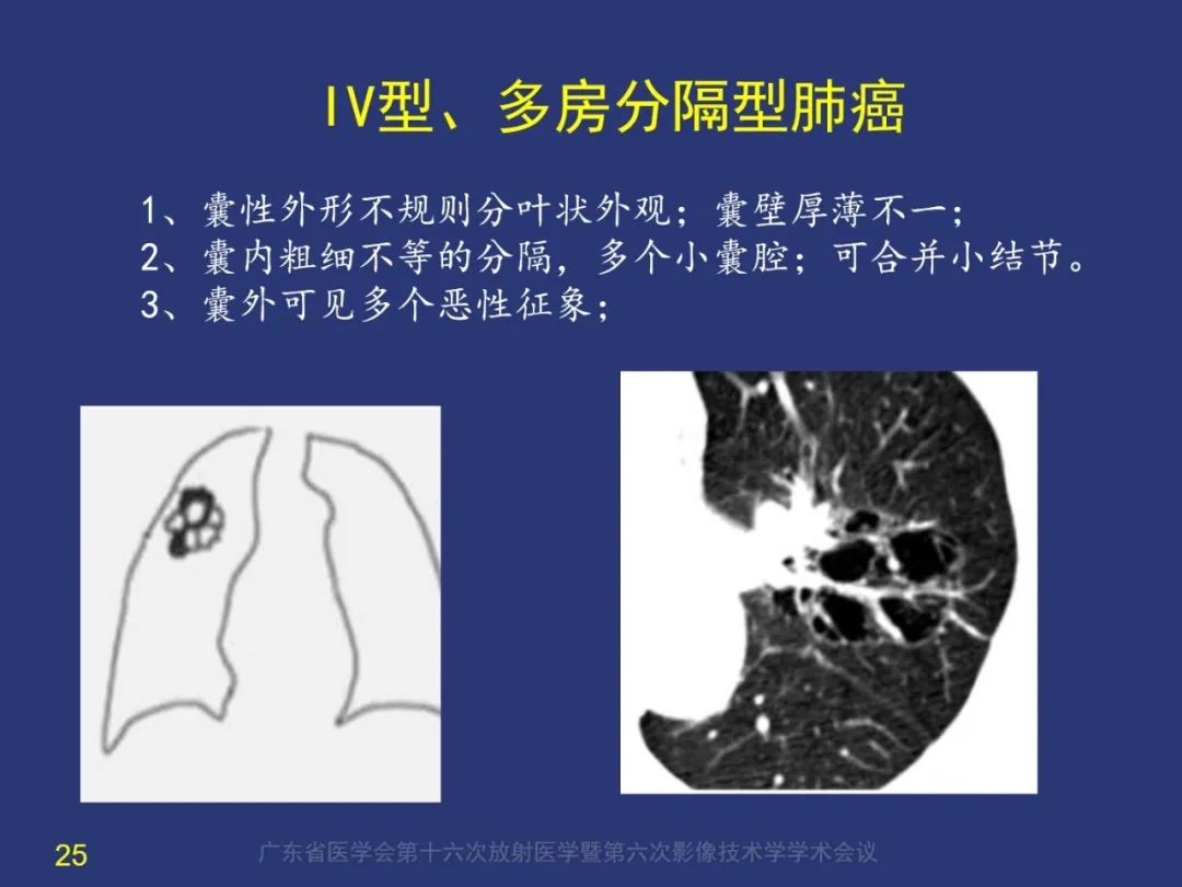 影像PPT - 【PPT】囊腔性肺癌的影像特征和鉴别诊断-25