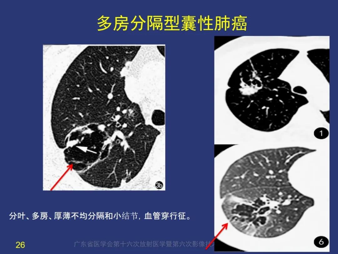 影像PPT - 【PPT】囊腔性肺癌的影像特征和鉴别诊断-26
