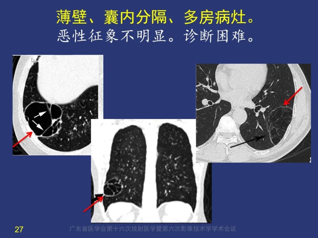 影像PPT - 【PPT】囊腔性肺癌的影像特征和鉴别诊断-27