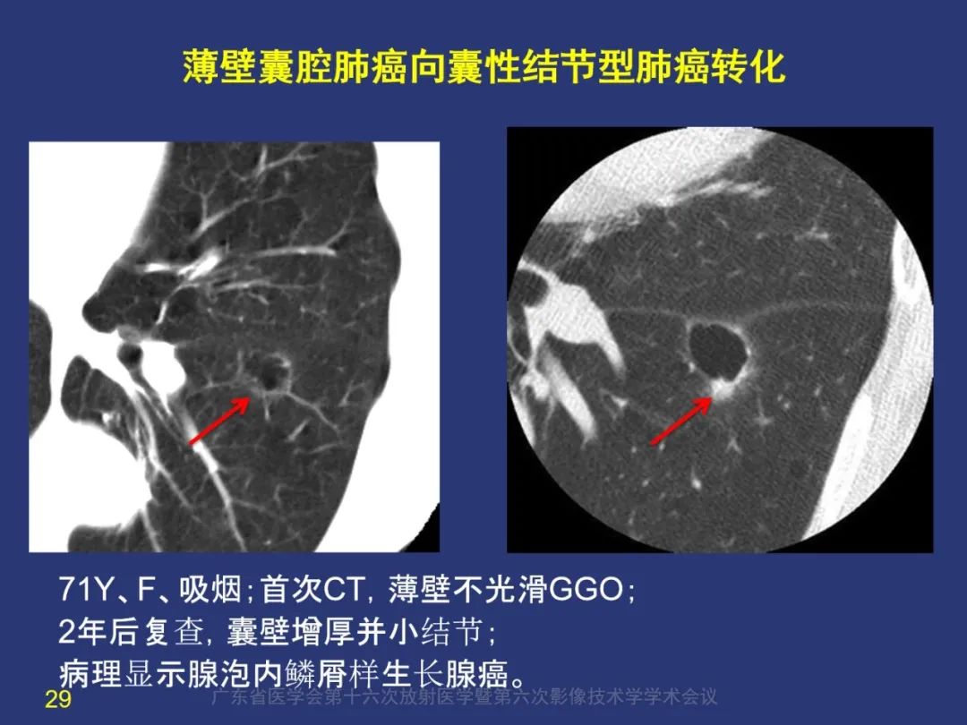 影像PPT - 【PPT】囊腔性肺癌的影像特征和鉴别诊断-29