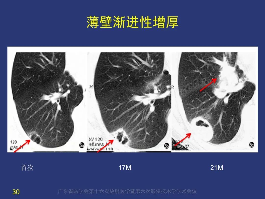 影像PPT - 【PPT】囊腔性肺癌的影像特征和鉴别诊断-30