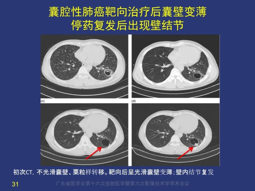 影像PPT - 【PPT】囊腔性肺癌的影像特征和鉴别诊断-31