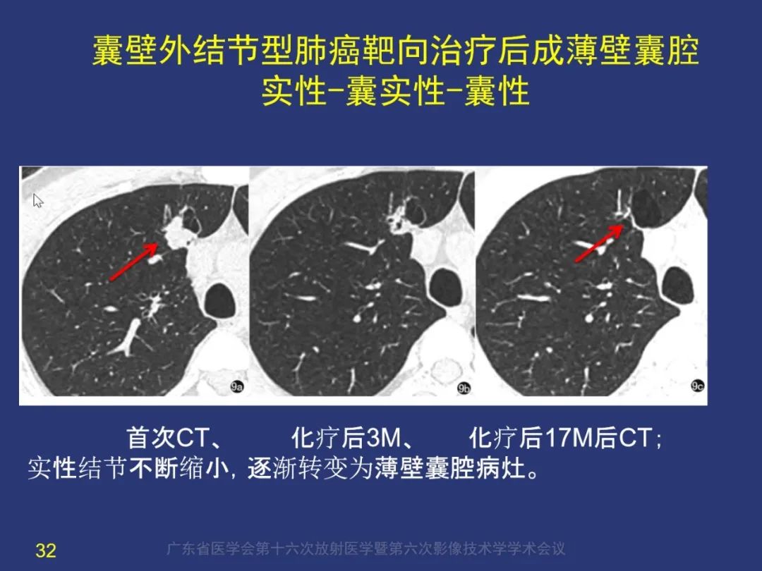 影像PPT - 【PPT】囊腔性肺癌的影像特征和鉴别诊断-32