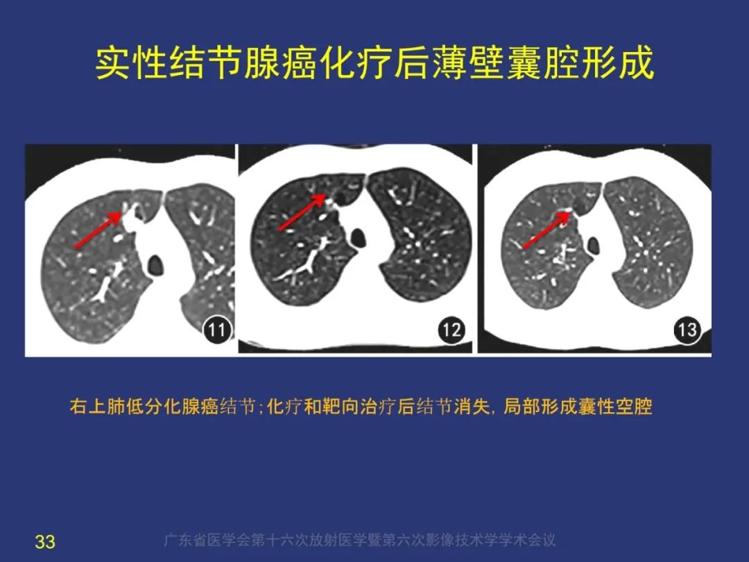 影像PPT - 【PPT】囊腔性肺癌的影像特征和鉴别诊断-33