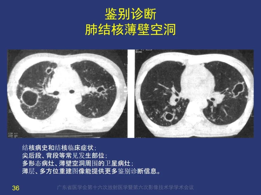影像PPT - 【PPT】囊腔性肺癌的影像特征和鉴别诊断-36