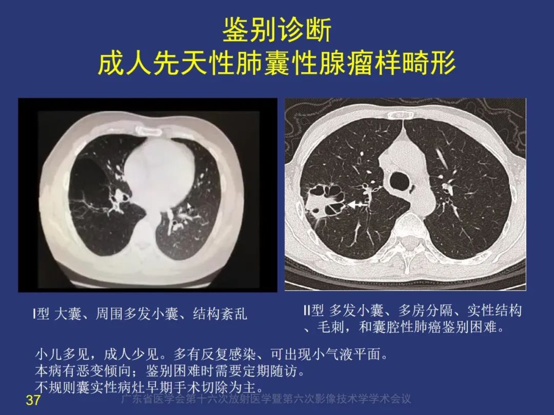 影像PPT - 【PPT】囊腔性肺癌的影像特征和鉴别诊断-37