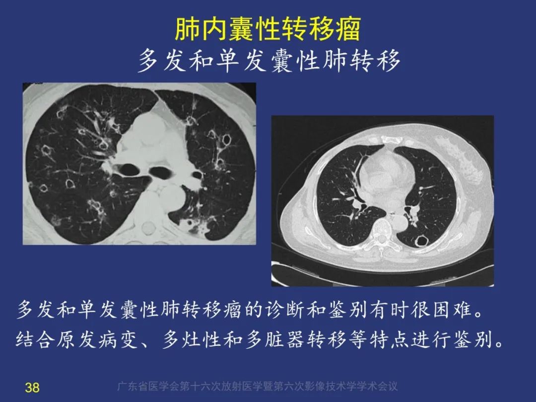 影像PPT - 【PPT】囊腔性肺癌的影像特征和鉴别诊断-38