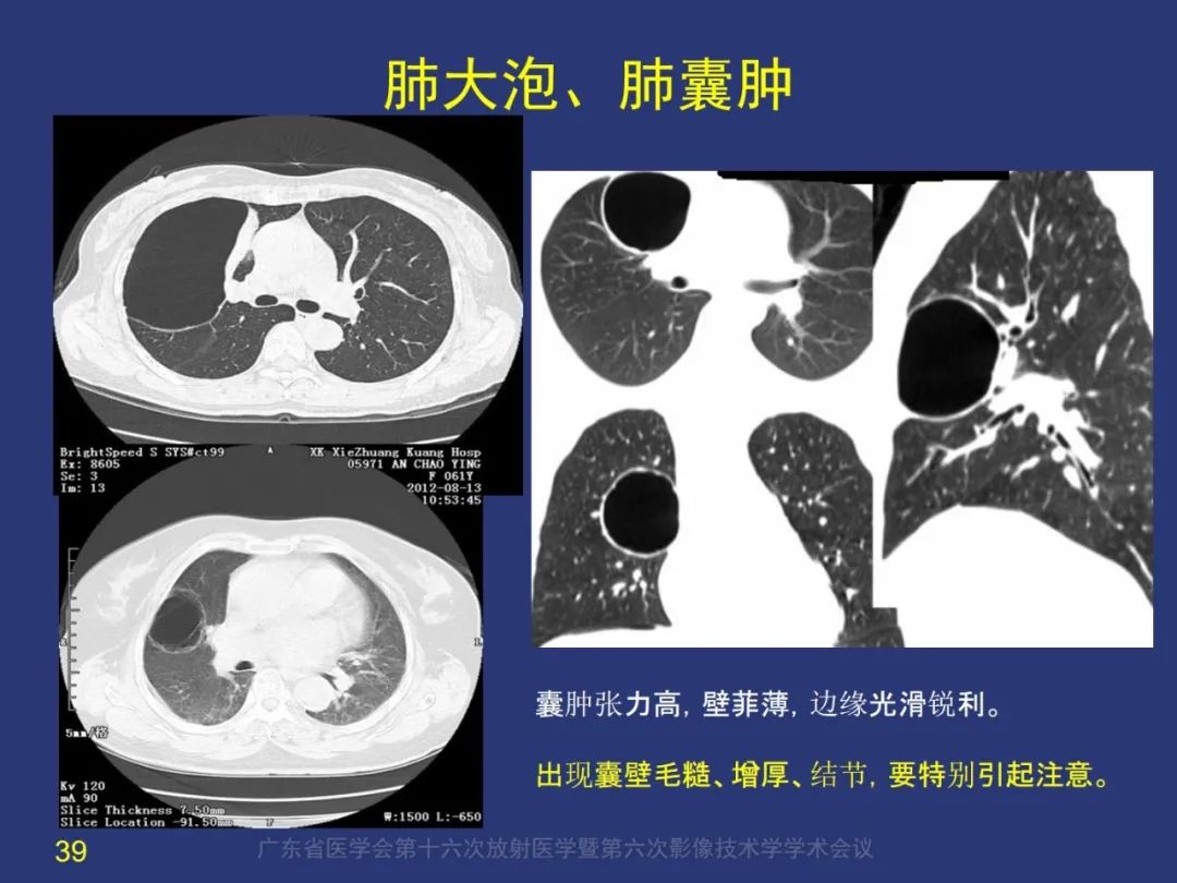 影像PPT - 【PPT】囊腔性肺癌的影像特征和鉴别诊断-39