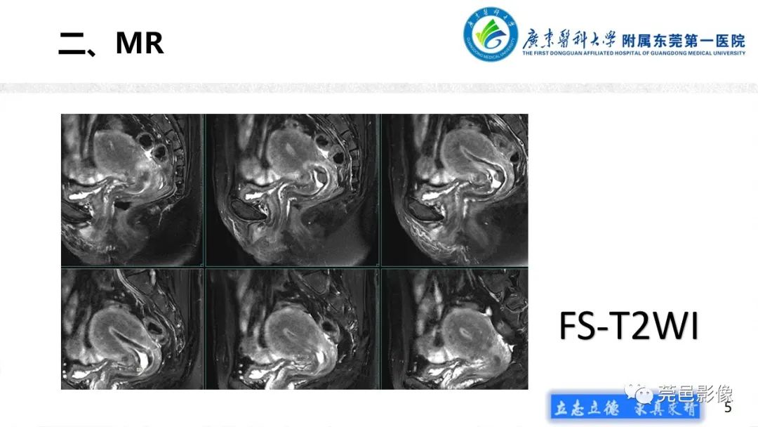 影像PPT - 【病例】不全流产1例超声及MR影像-5