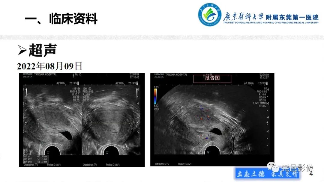 影像PPT - 【病例】不全流产1例超声及MR影像-4