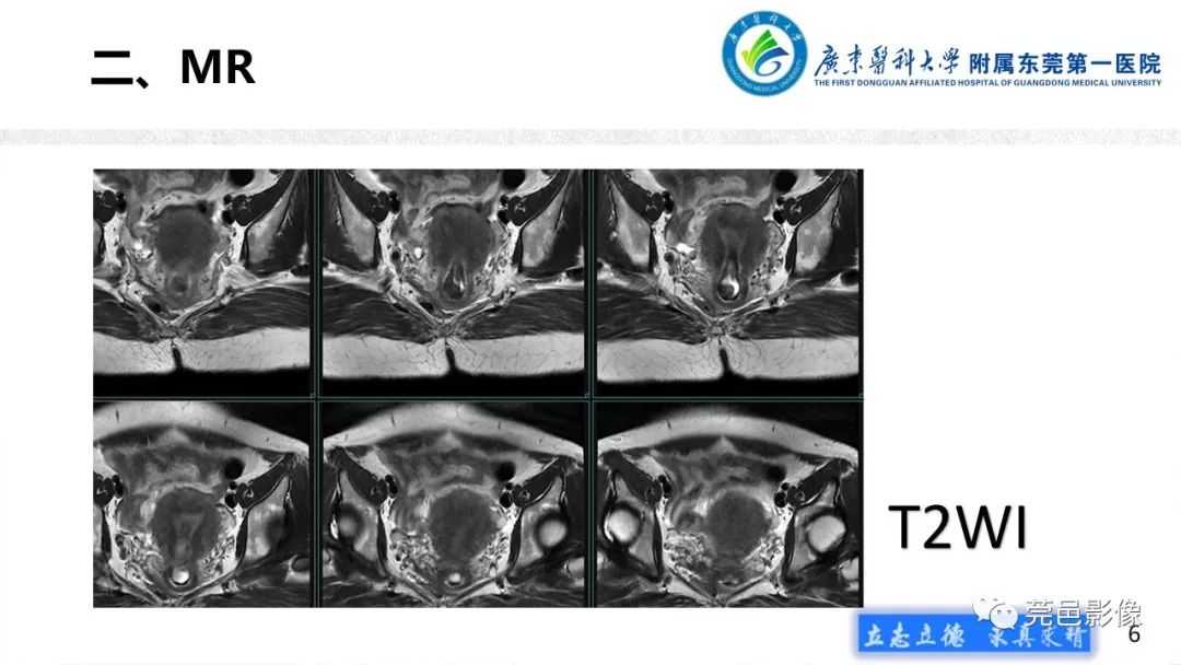 影像PPT - 【病例】不全流产1例超声及MR影像-6