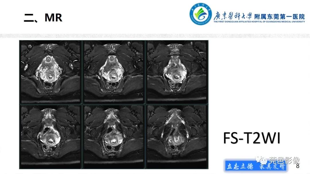 影像PPT - 【病例】不全流产1例超声及MR影像-8