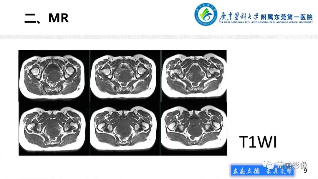 影像PPT - 【病例】不全流产1例超声及MR影像-9