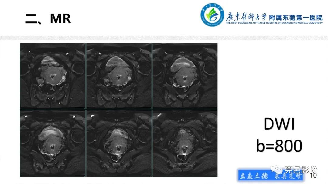影像PPT - 【病例】不全流产1例超声及MR影像-10