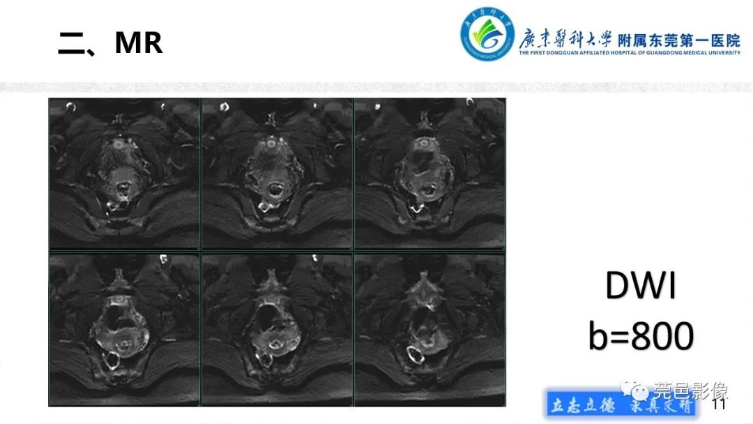 影像PPT - 【病例】不全流产1例超声及MR影像-11