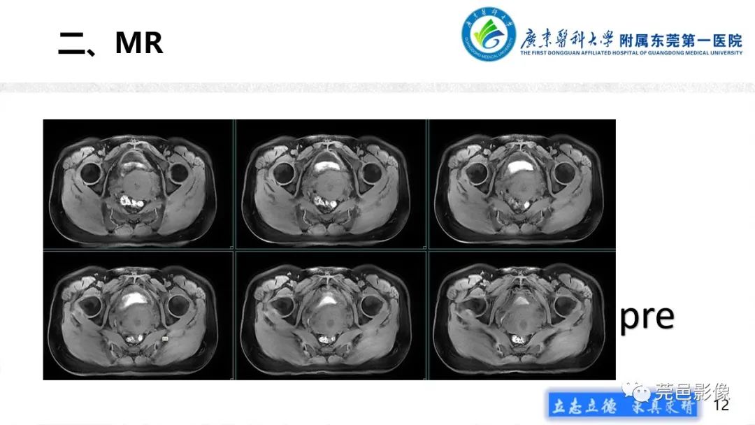 影像PPT - 【病例】不全流产1例超声及MR影像-12