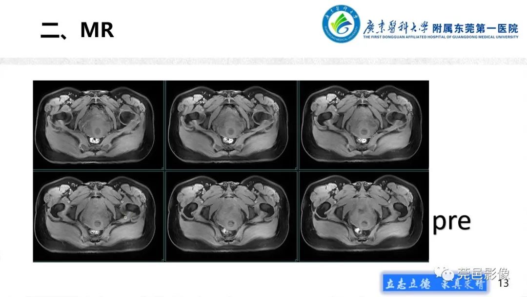 影像PPT - 【病例】不全流产1例超声及MR影像-13
