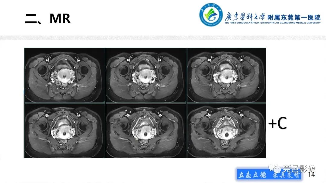 影像PPT - 【病例】不全流产1例超声及MR影像-14
