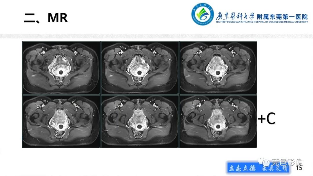 影像PPT - 【病例】不全流产1例超声及MR影像-15