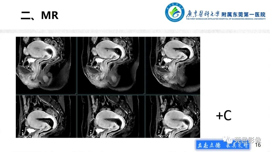 影像PPT - 【病例】不全流产1例超声及MR影像-16