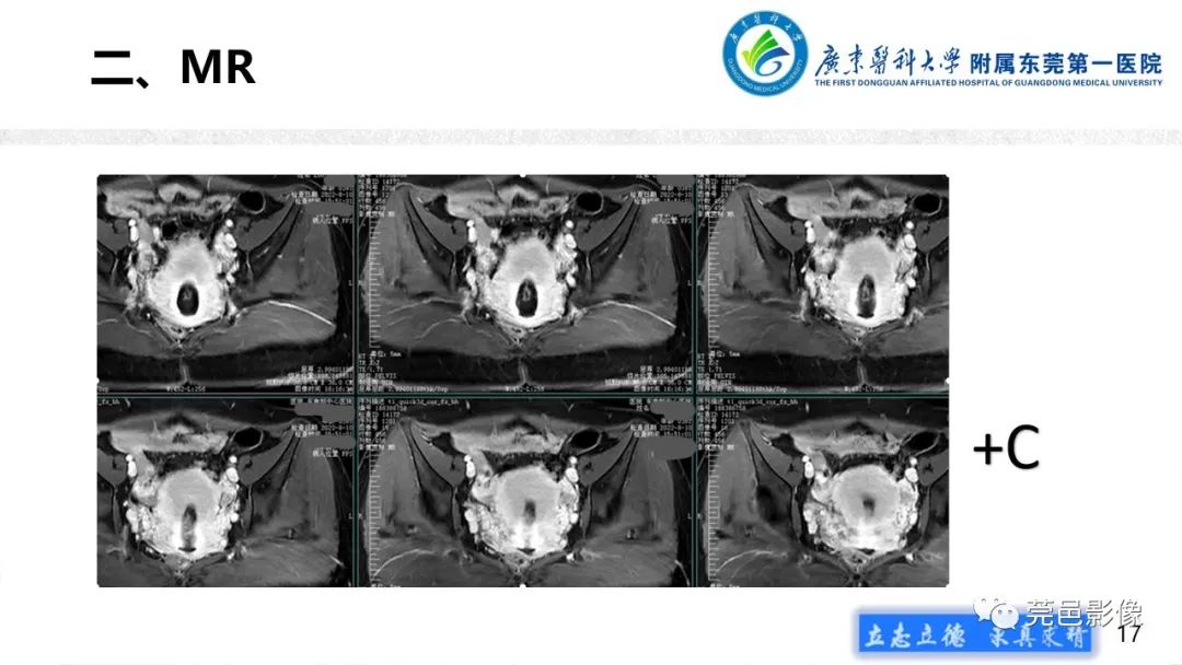 影像PPT - 【病例】不全流产1例超声及MR影像-17
