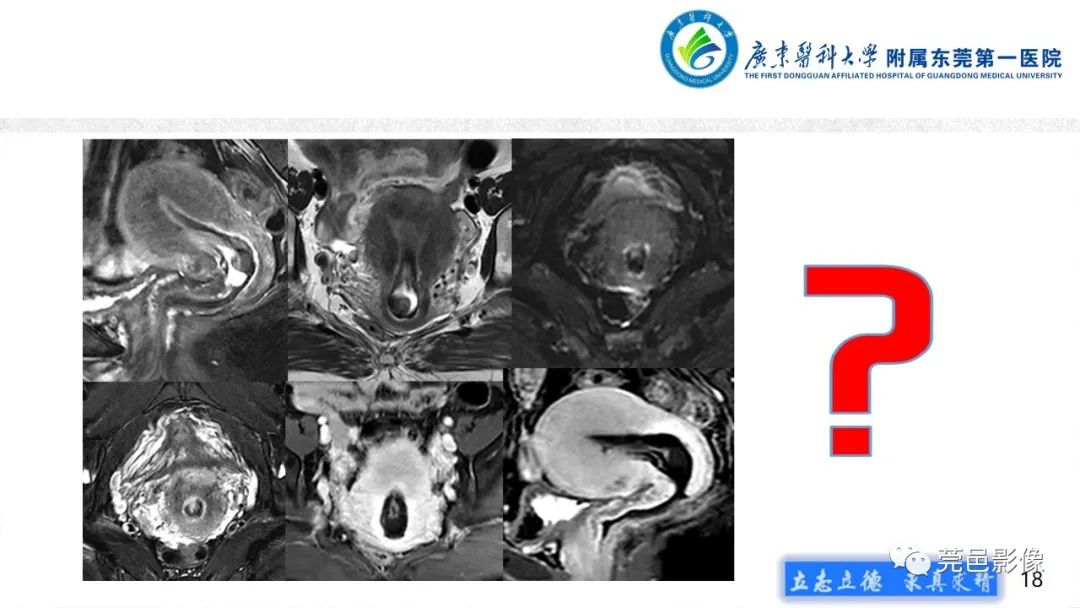 影像PPT - 【病例】不全流产1例超声及MR影像-18
