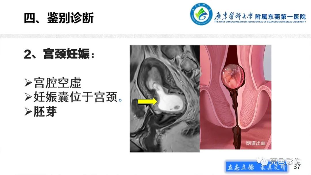 影像PPT - 【病例】不全流产1例超声及MR影像-37
