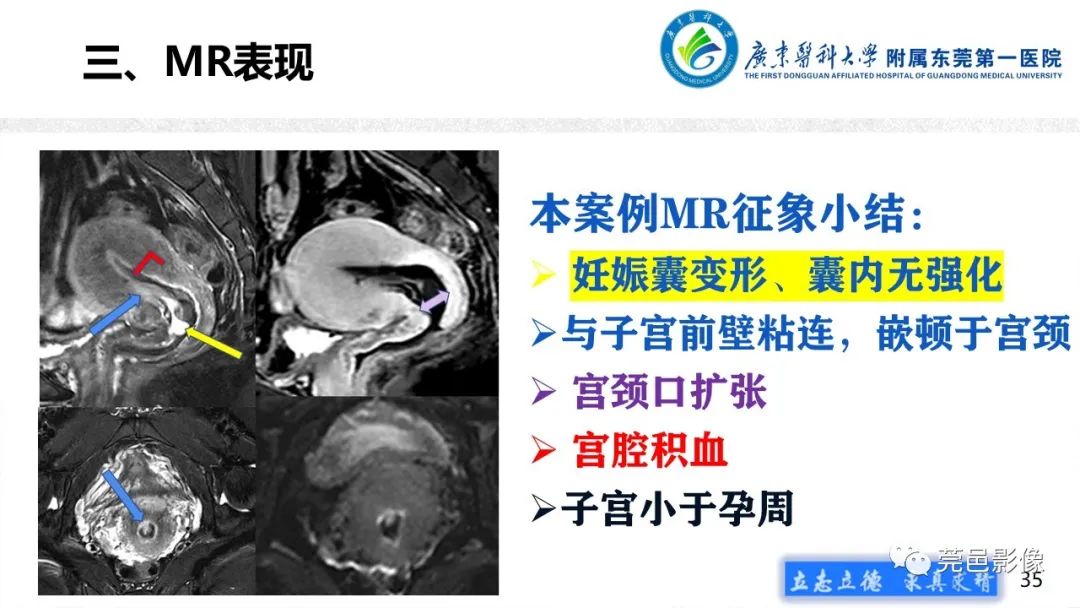 影像PPT - 【病例】不全流产1例超声及MR影像-35