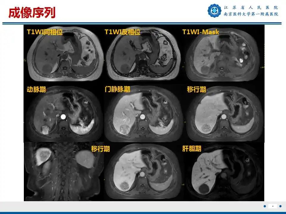 影像PPT - 【PPT】肝细胞癌—肝脏肿瘤术前MR评估-5