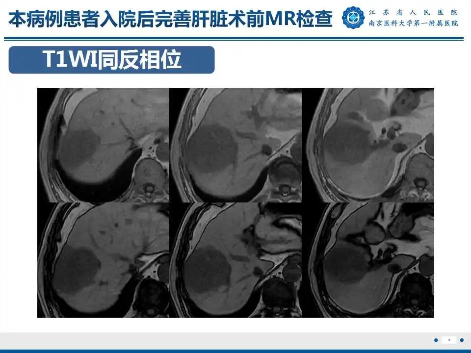 影像PPT - 【PPT】肝细胞癌—肝脏肿瘤术前MR评估-7