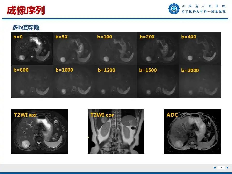 影像PPT - 【PPT】肝细胞癌—肝脏肿瘤术前MR评估-6
