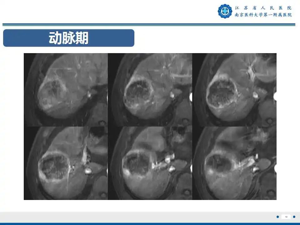影像PPT - 【PPT】肝细胞癌—肝脏肿瘤术前MR评估-11