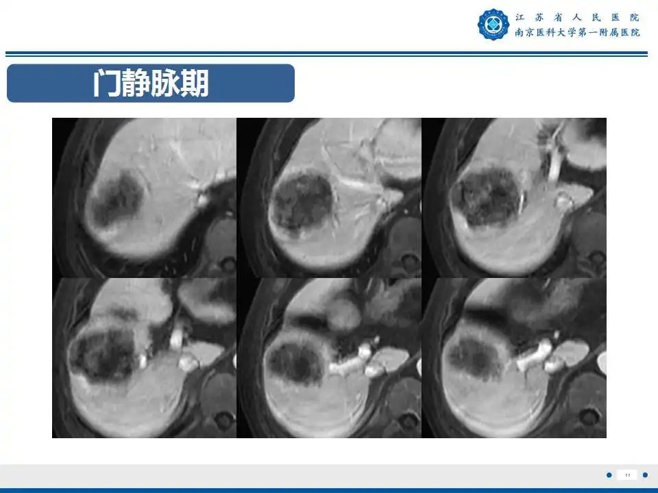 影像PPT - 【PPT】肝细胞癌—肝脏肿瘤术前MR评估-12