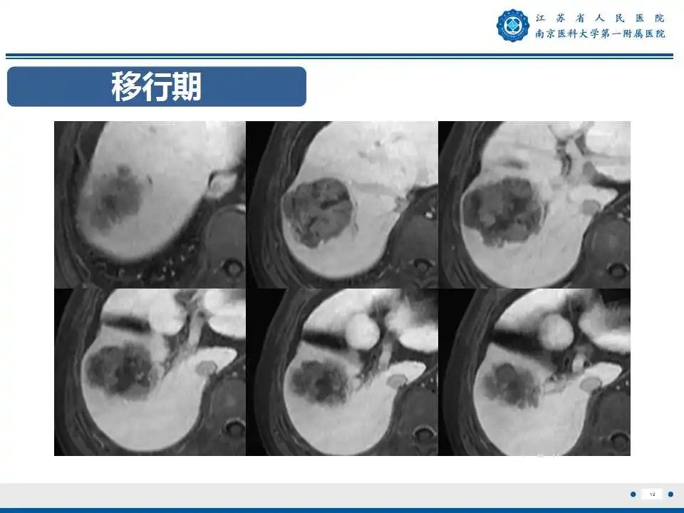 影像PPT - 【PPT】肝细胞癌—肝脏肿瘤术前MR评估-13