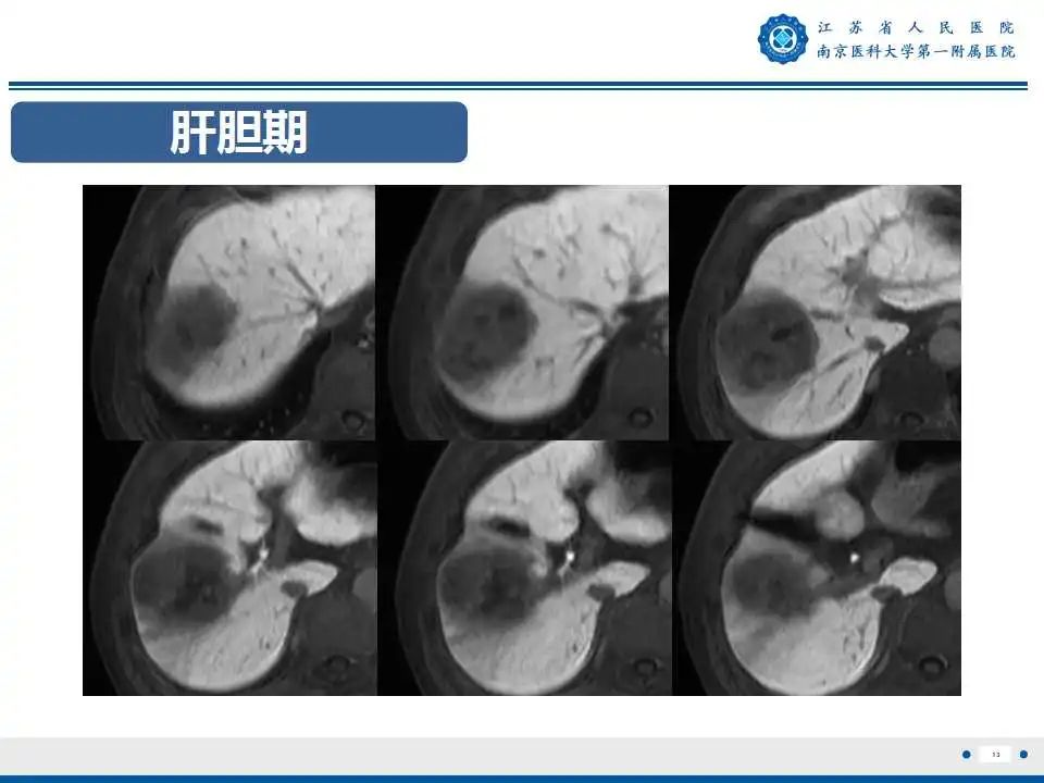 影像PPT - 【PPT】肝细胞癌—肝脏肿瘤术前MR评估-14
