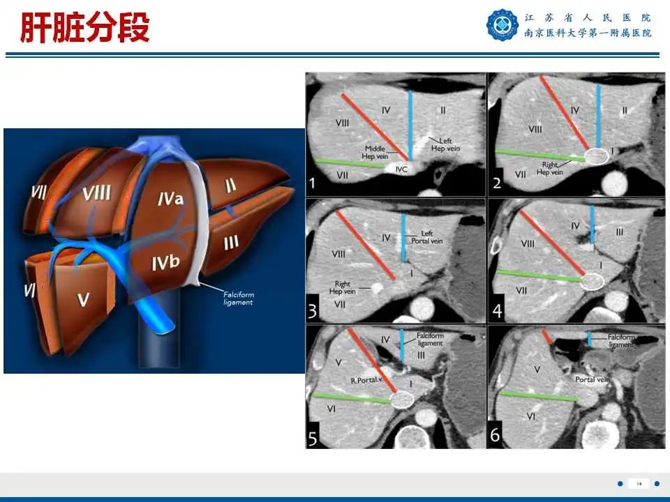 影像PPT - 【PPT】肝细胞癌—肝脏肿瘤术前MR评估-17