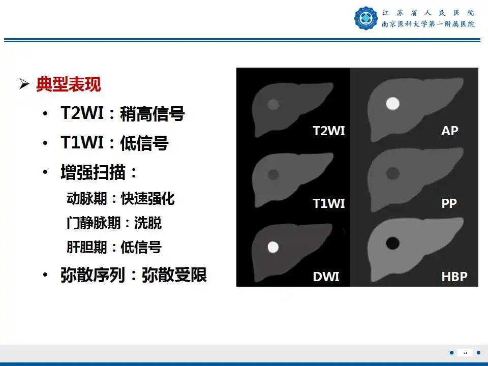 影像PPT - 【PPT】肝细胞癌—肝脏肿瘤术前MR评估-29