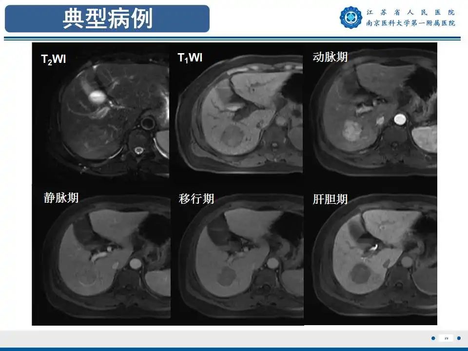 影像PPT - 【PPT】肝细胞癌—肝脏肿瘤术前MR评估-30