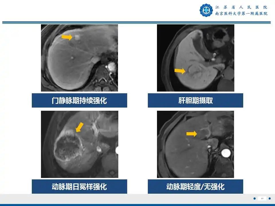 影像PPT - 【PPT】肝细胞癌—肝脏肿瘤术前MR评估-32