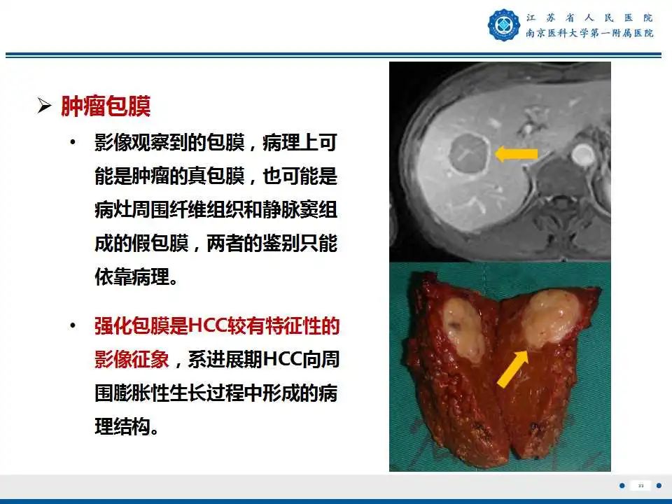 影像PPT - 【PPT】肝细胞癌—肝脏肿瘤术前MR评估-34