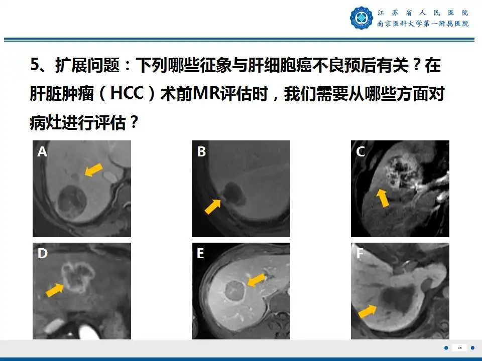 影像PPT - 【PPT】肝细胞癌—肝脏肿瘤术前MR评估-36