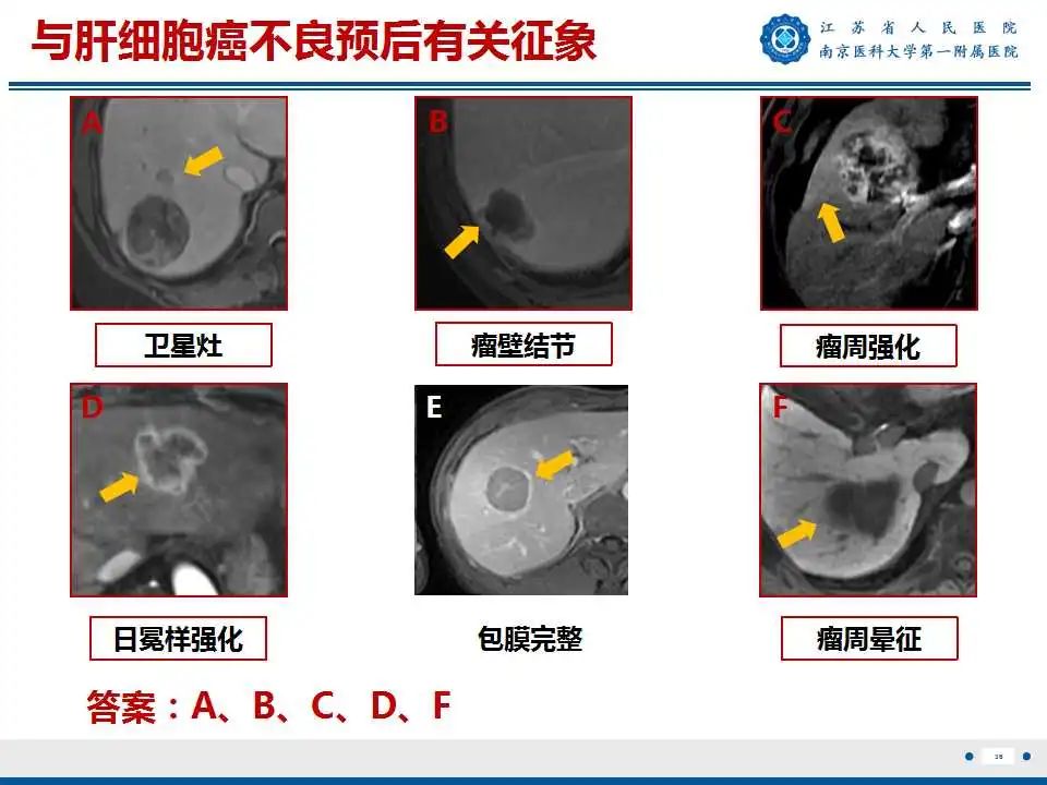 影像PPT - 【PPT】肝细胞癌—肝脏肿瘤术前MR评估-37
