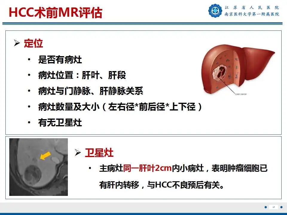 影像PPT - 【PPT】肝细胞癌—肝脏肿瘤术前MR评估-38