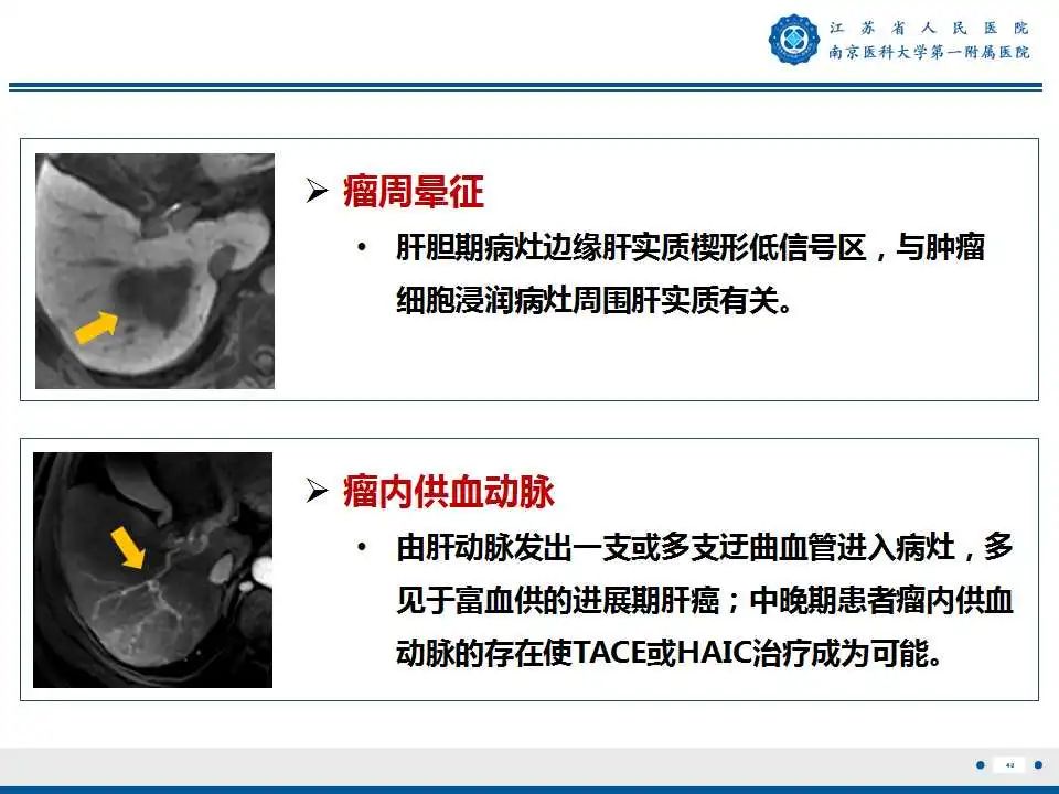 影像PPT - 【PPT】肝细胞癌—肝脏肿瘤术前MR评估-41