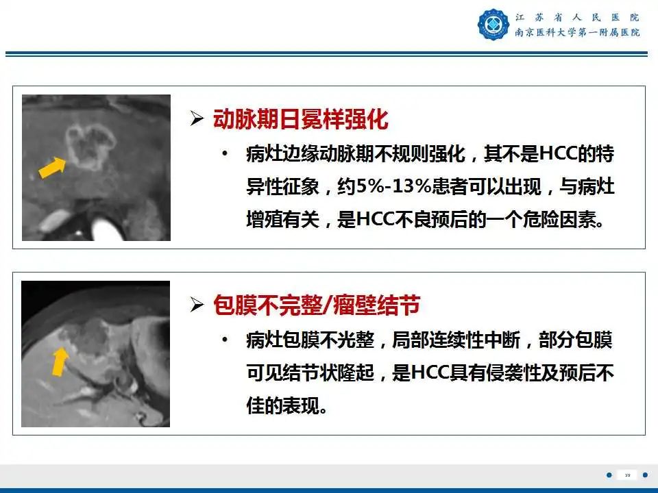 影像PPT - 【PPT】肝细胞癌—肝脏肿瘤术前MR评估-40