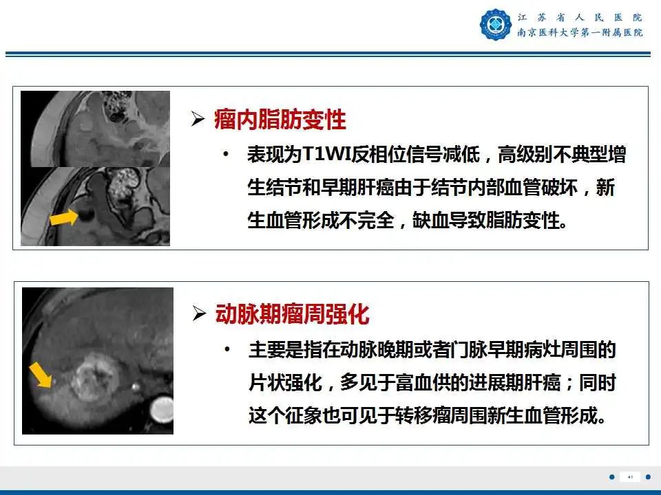 影像PPT - 【PPT】肝细胞癌—肝脏肿瘤术前MR评估-42