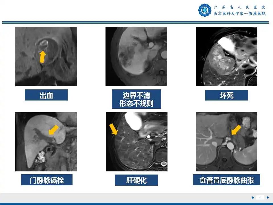 影像PPT - 【PPT】肝细胞癌—肝脏肿瘤术前MR评估-43
